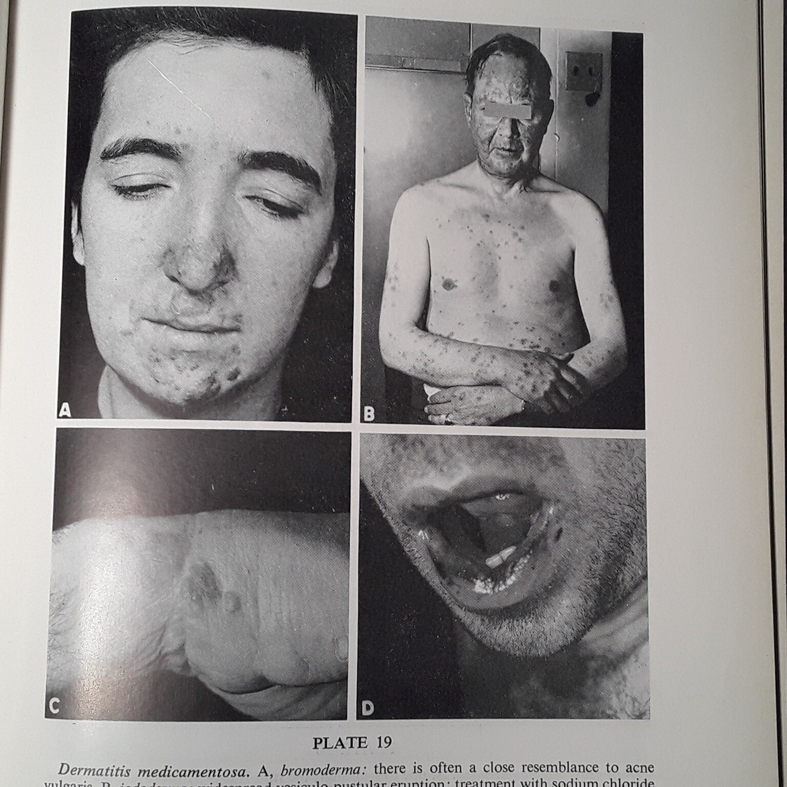 Practical Dermatology by George M. Lewis M.D. (Hardcover 1955)