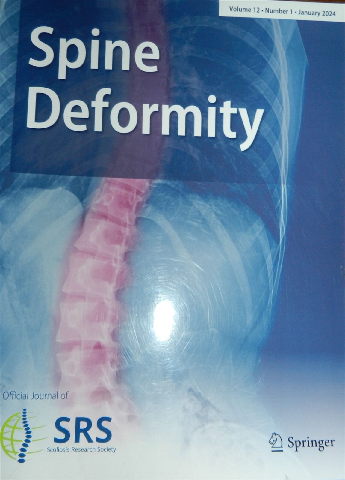 Spine Deformity Volume 12 2 Book Set! Number 1 January 2024! Number 2 March 2024